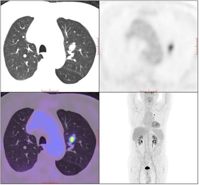 Case report: Pulmonary sarcomatoid carcinoma demonstrating rapid growth on follow-up CT